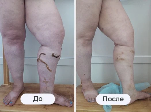 фотография до и после лазерного лечения в клинике Варикоза нет в Воронеже